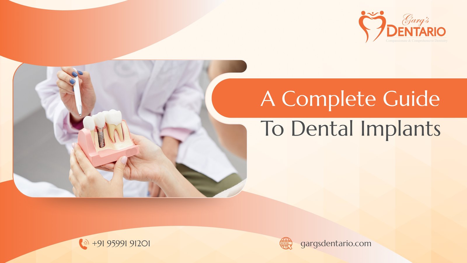 A Complete Guide to Dental Implants