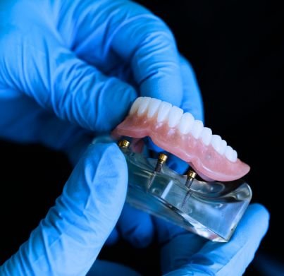 Overdenture