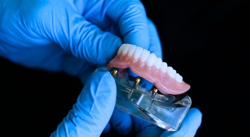 Overdenture