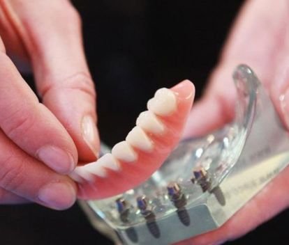 Types Of Overdenture