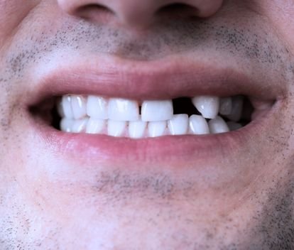 Who Needs Dental Implants?