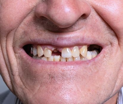 Who Needs Full Mouth Rehabilitation?