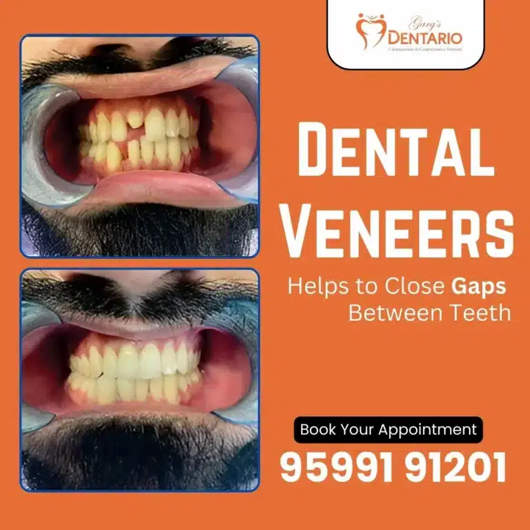 Dental Veneers Treatment