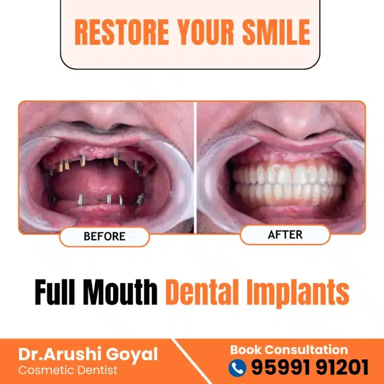 Full Mouth Dental Implants