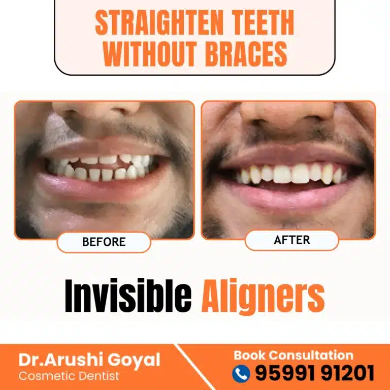 Invisible Aligners Dental Treatment