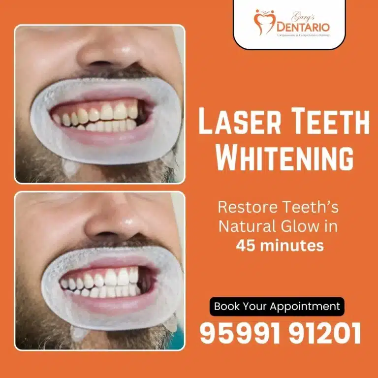 Laser Teeth Whitening Dental Treatment