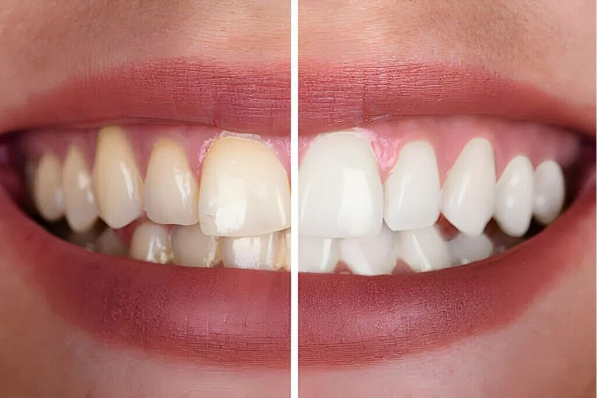 Teeth Whitening