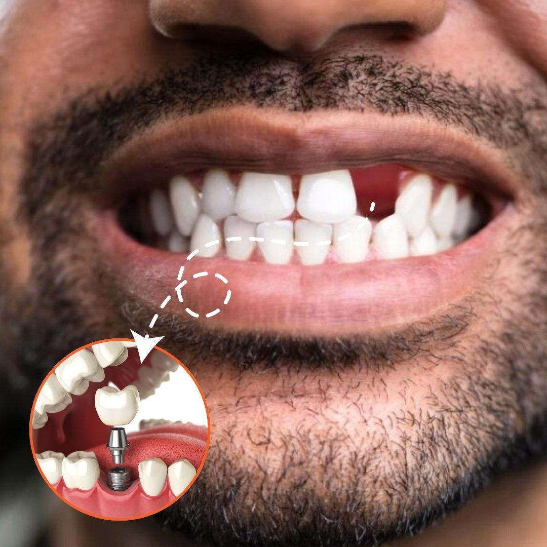 dental  implants